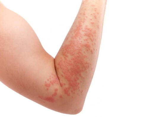 Vrste dermatitisa - atopični dermatitis